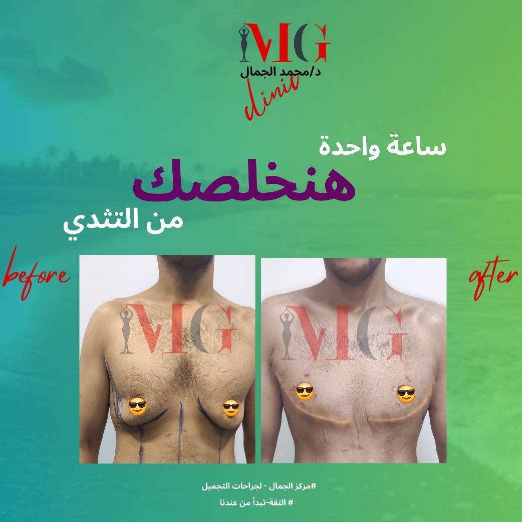 نتيجة تجميل الثدي — قبل وبعد